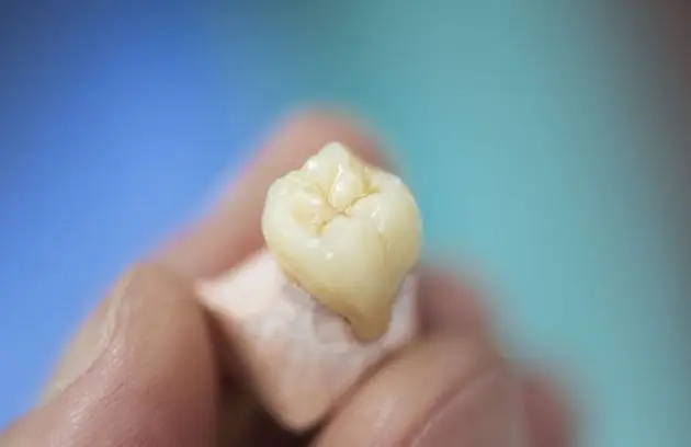 Dental Crowns