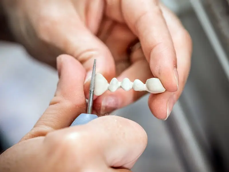 What are Dental Bridges